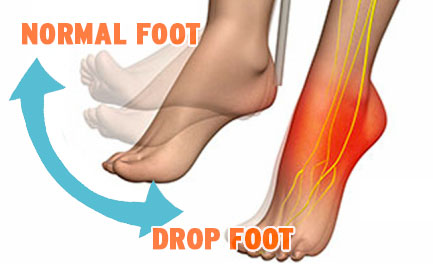 Phoenix Waveform, Neubie, ARPwave, Treating Foot drop