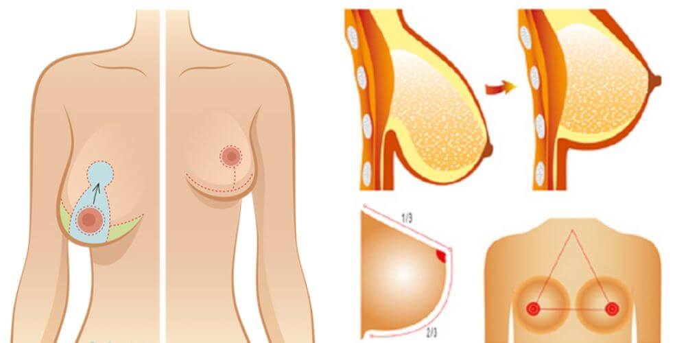 Comparaison des seins