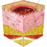 Braden Scale 4 Pressure Ulcer