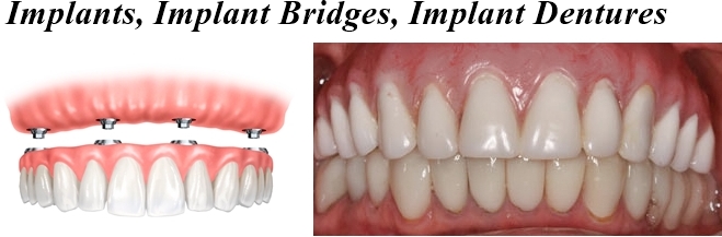 dentureimplantsmile 7.jpg