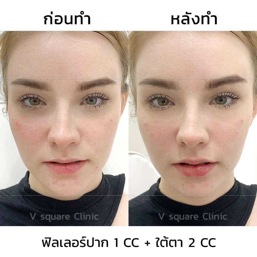 รีวิวฉีดฟิลเลอร์เห็นผลทันทีหลังทำ 1