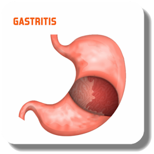 Download Treat Gastritis For PC Windows and Mac