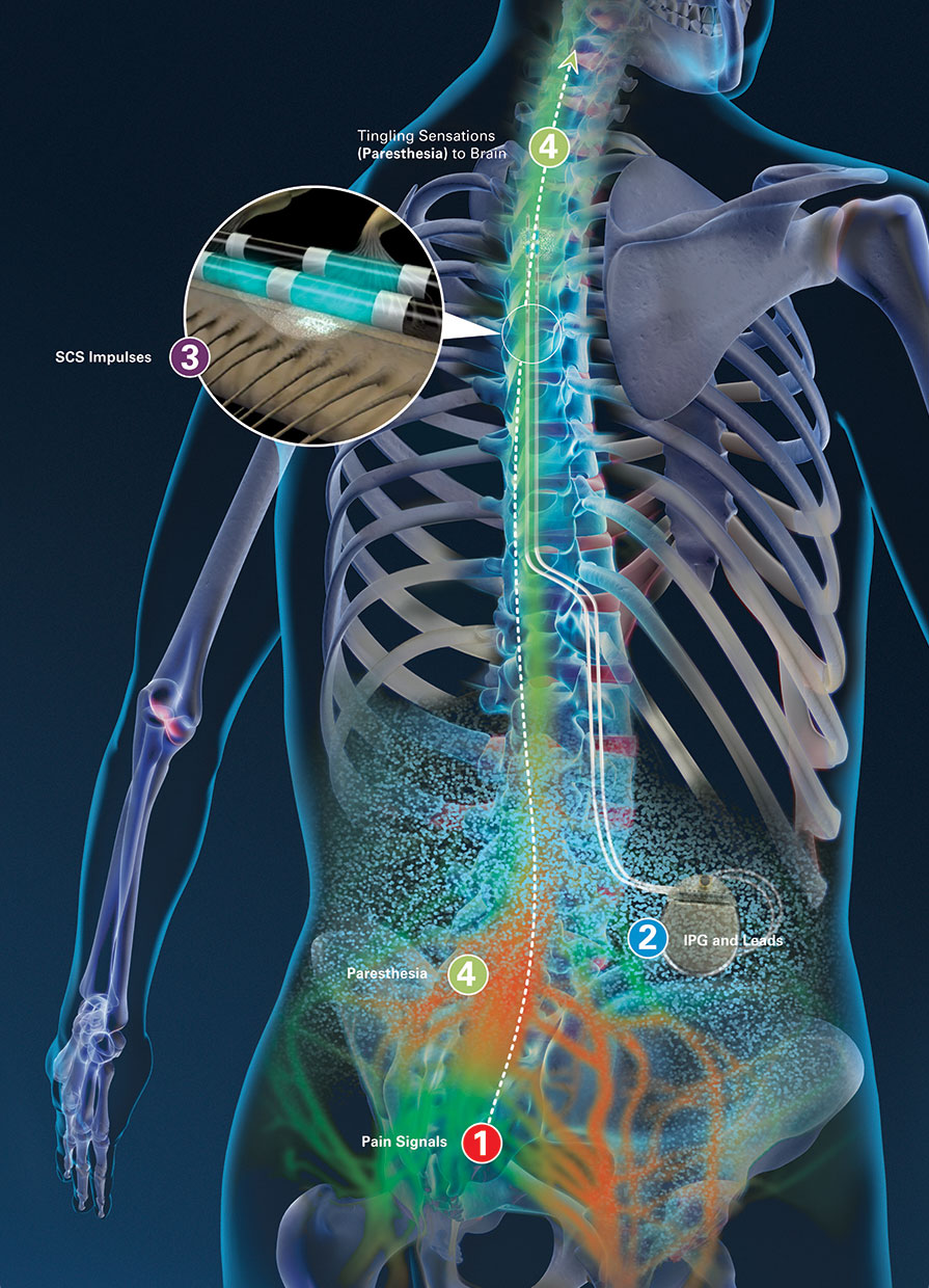 Boston-scientific-spinal-cord-stimulator
