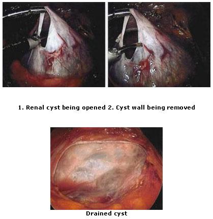 kidney cancer