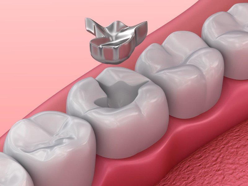 Kim loại chịu lực tốt nên được sử dụng để hàn răng hàm