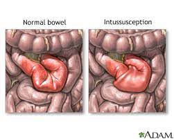 Intestinal obstruction (pediatric) - series | Lima Memorial Health System