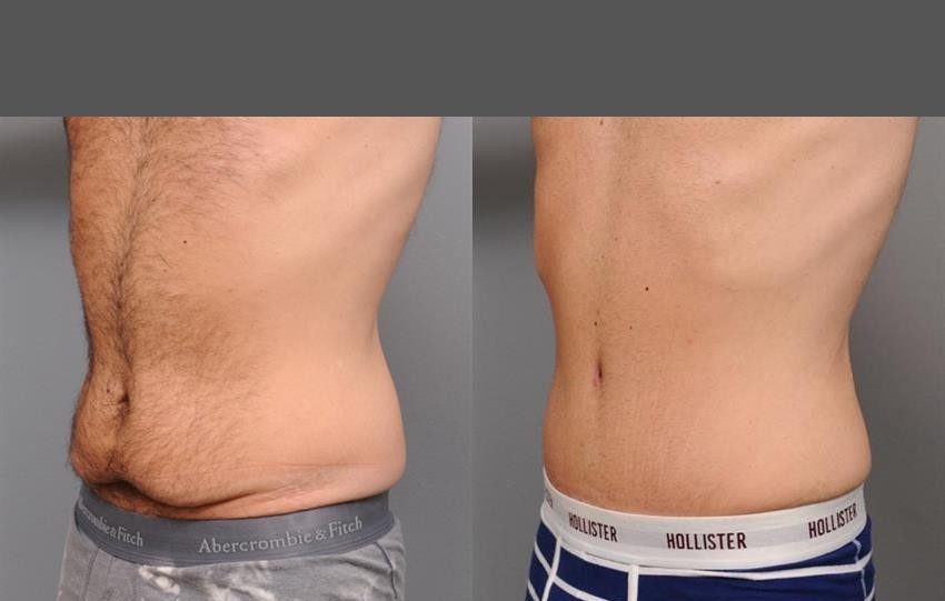 Tummy Tuck Before and After