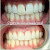 Teeth from a patient before and after intervention. 