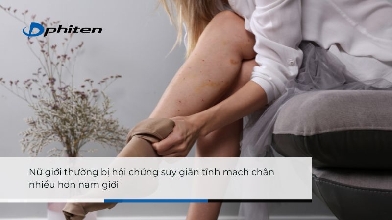 Nữ giới thường bị hội chứng suy giãn tĩnh mạch chân nhiều hơn nam giới