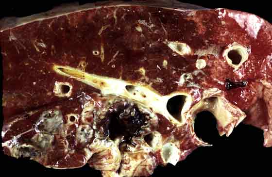 Gangrenous pneumonia, cross section, illustrating cavitation of lung tissue due to necrosis, consolidation with exudate and lung collapse.