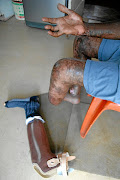 The day the Soweto man will never forget. He lost his leg and suffered severe burns. /Ziphozonke Lushaba