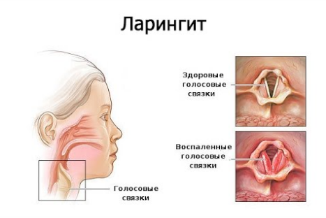 Восстановление голоса после хирургического вмешательства в области шеи