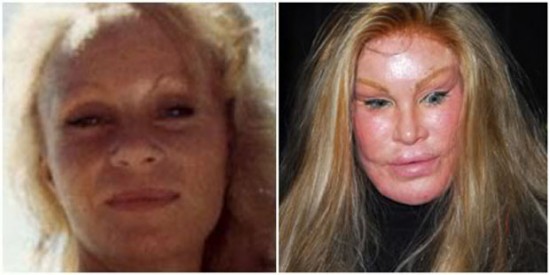 donatella versace before surgery. Donatella Versace