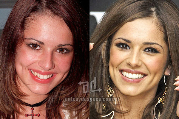 The new smile of Cheryl Cole, afterdental surgery