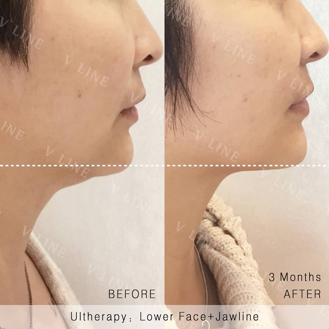 Ultherapy before and after results of a client who came in for a jawline and neck lift