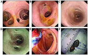 Gastroscopy