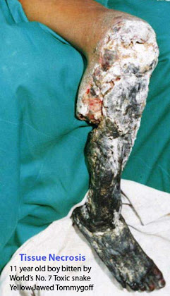 tissue necrosis snakebite