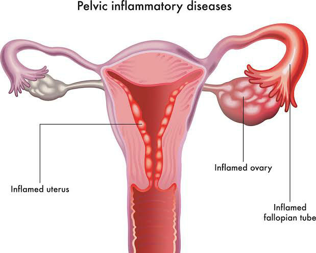 Does Pelvic Inflammatory Disease Show On Ultrasound?