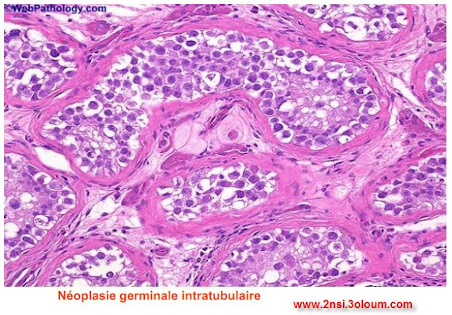 Les tumeurs greminales  de testicule 3