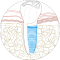 Dental Implantat