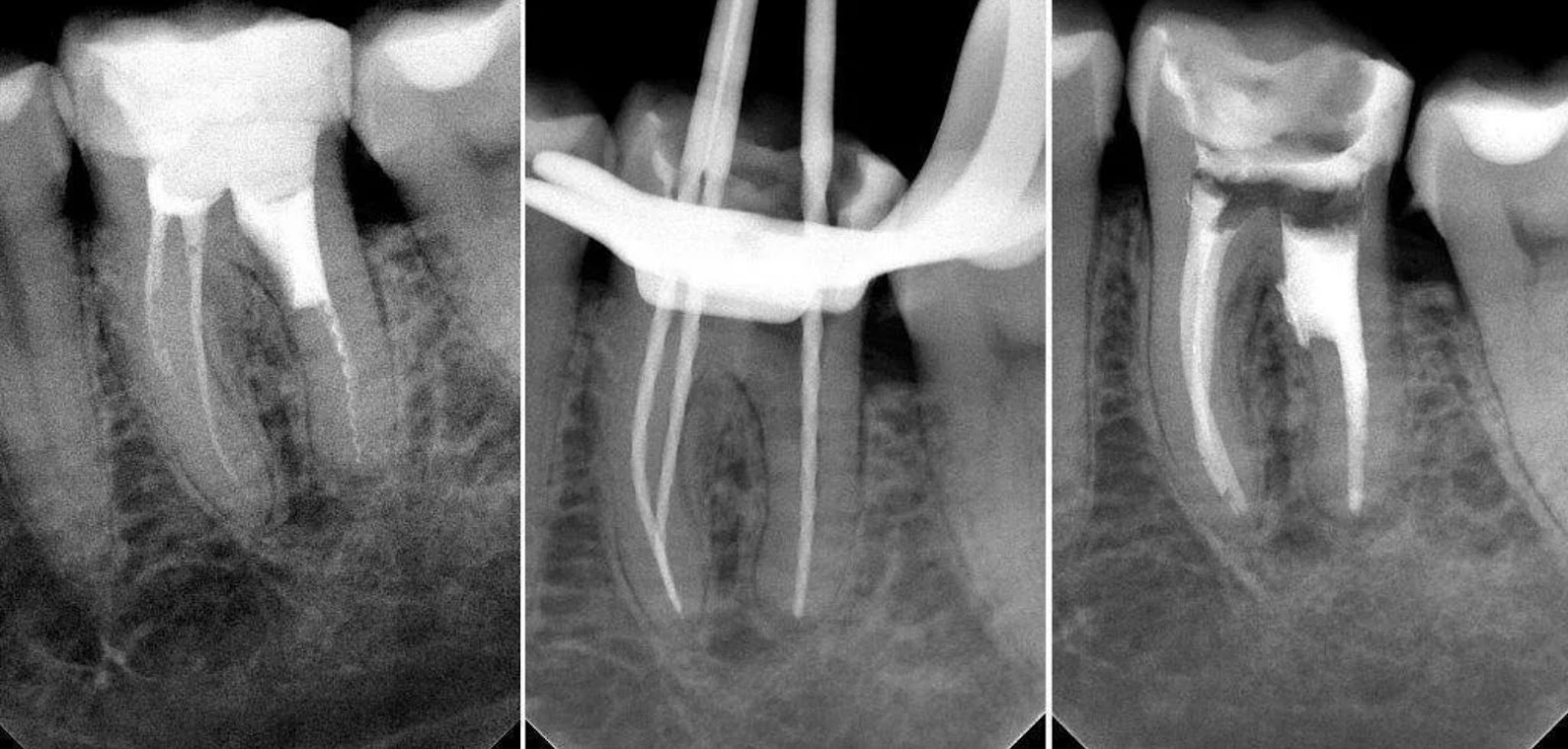 1 корневой канал. Обтурация корневого канала рентген. Гуттаперчевый штифт на рентгене. Периапикальный периодонтит кт. Запломбированные корневые каналы зуба.