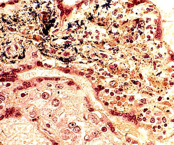 Acute necrotizing villitis in langur villi, Gram stain. Not black organisms and necrosis of villous core. Fetal demise