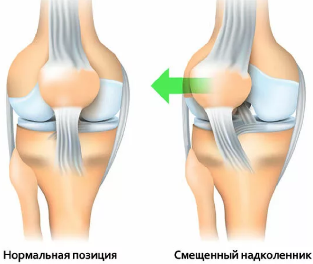 Лечение травм коленного сустава. Травмы коленного сустава у спортсменов. Оперативное лечение повреждений. Травмы коленного сустава (разрывы) — народные методы лечения - Советы. Боль в колене сбоку с внутренней стороны - почему и как лечить