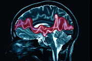 Scan of a brain with epilepsy