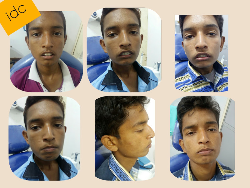 At work — Indra Dental Clinic idc... 🦷 7525885385, Aziz Nagar, Lucknow