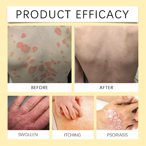 Title 5, Cowhide Moss Care Soap Relieves Discomfort and ...