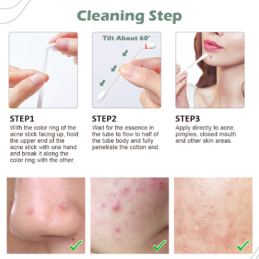 Title 7, Salicylic Acid Acne Remover to Lighten Marks. E...
