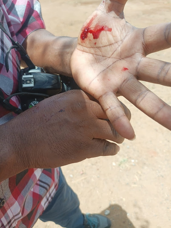 Star Journalist Musembi Nzengu injured hands while he was covering arrival of a school head in Kitui County on February 2024.