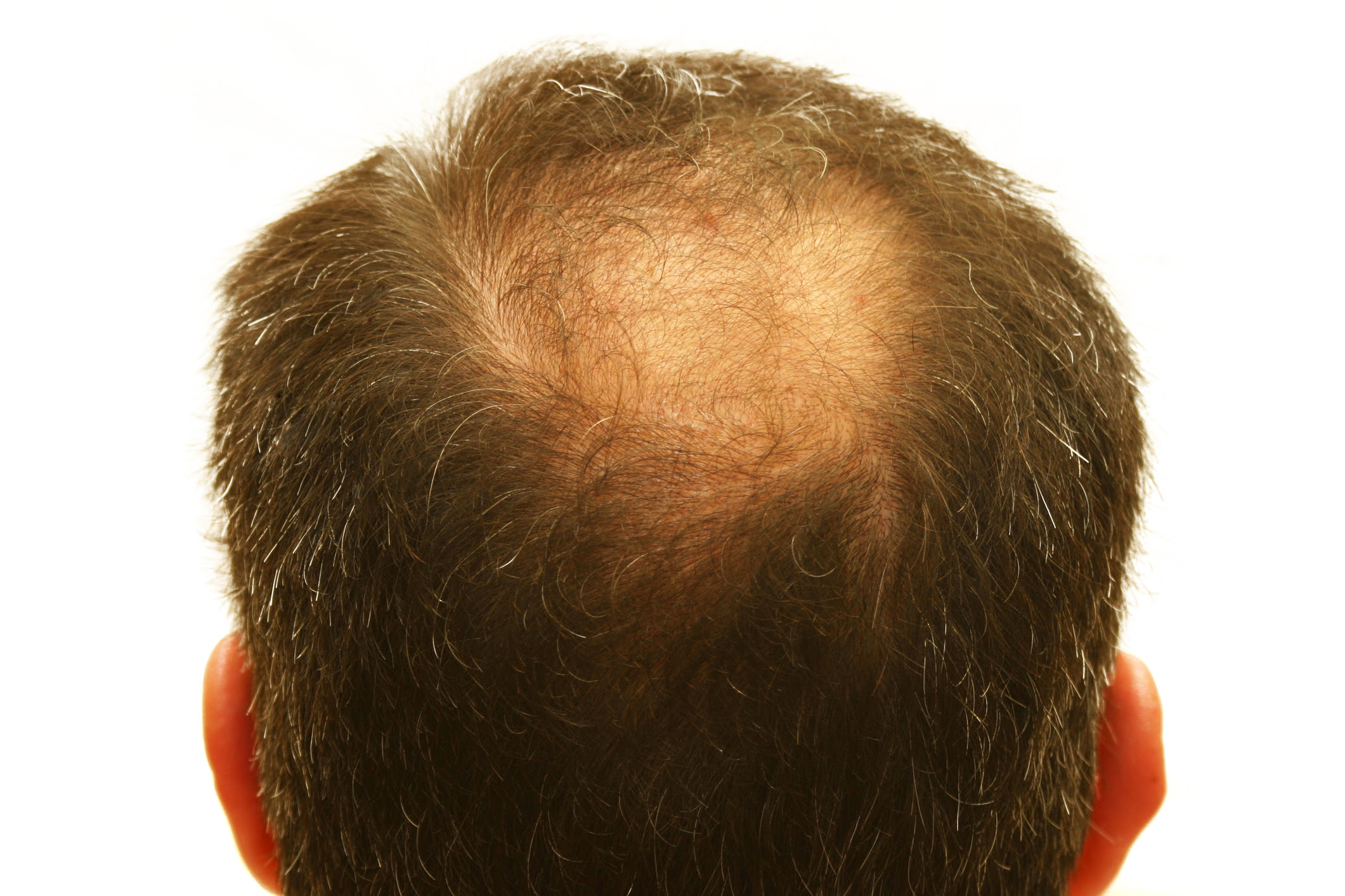 Top 5 Natural Hair Loss Treatment For Men My Simple Remedies