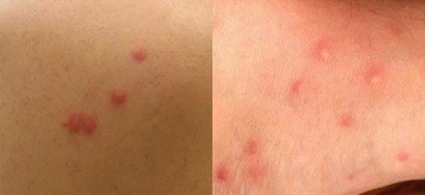 Closeups of bed bug bites (left) and flea bites (right) on human skin.