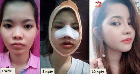 phẫu thuật nâng mũi S line-7