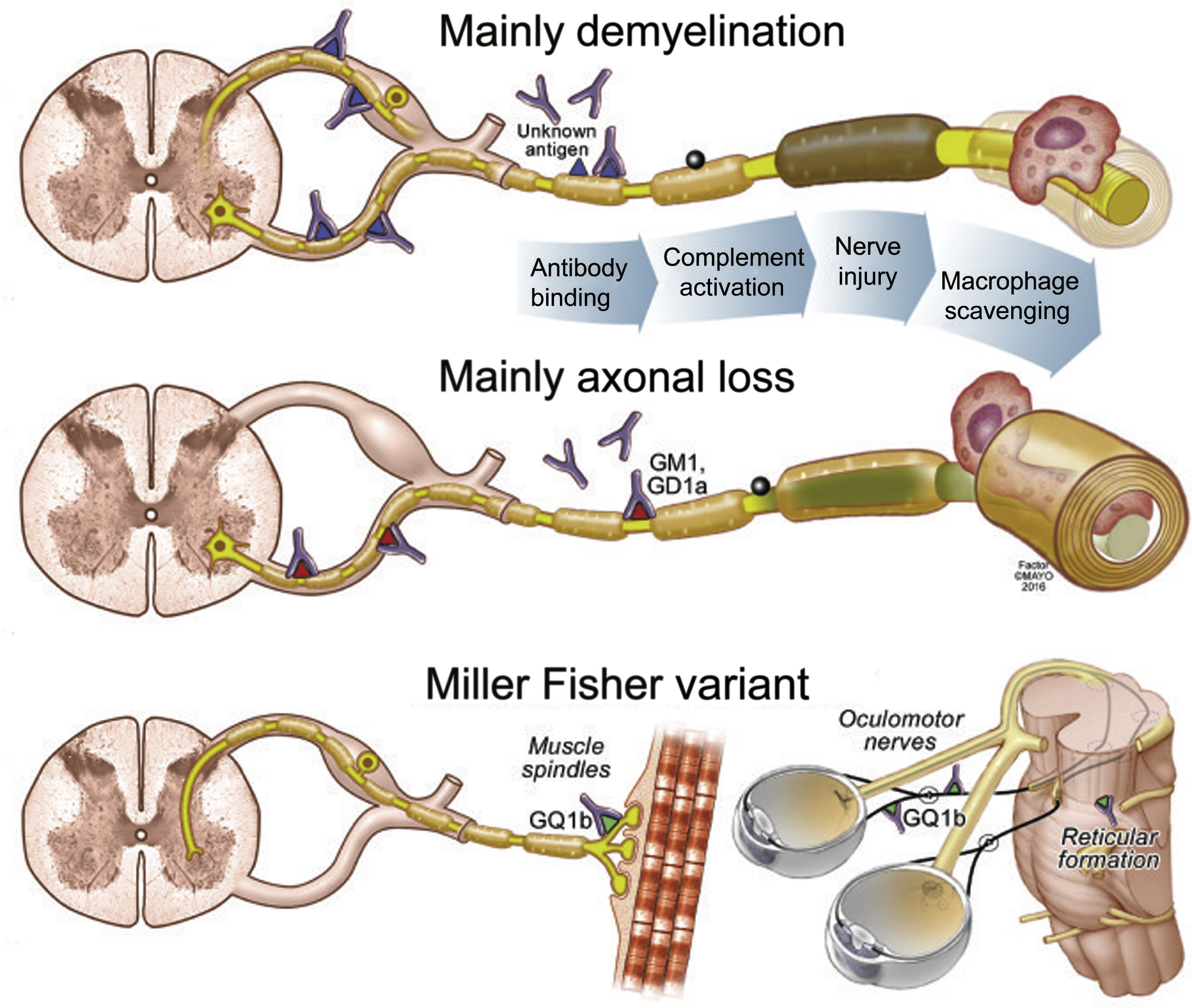 mayo clinic guillain barre syndrome symptoms