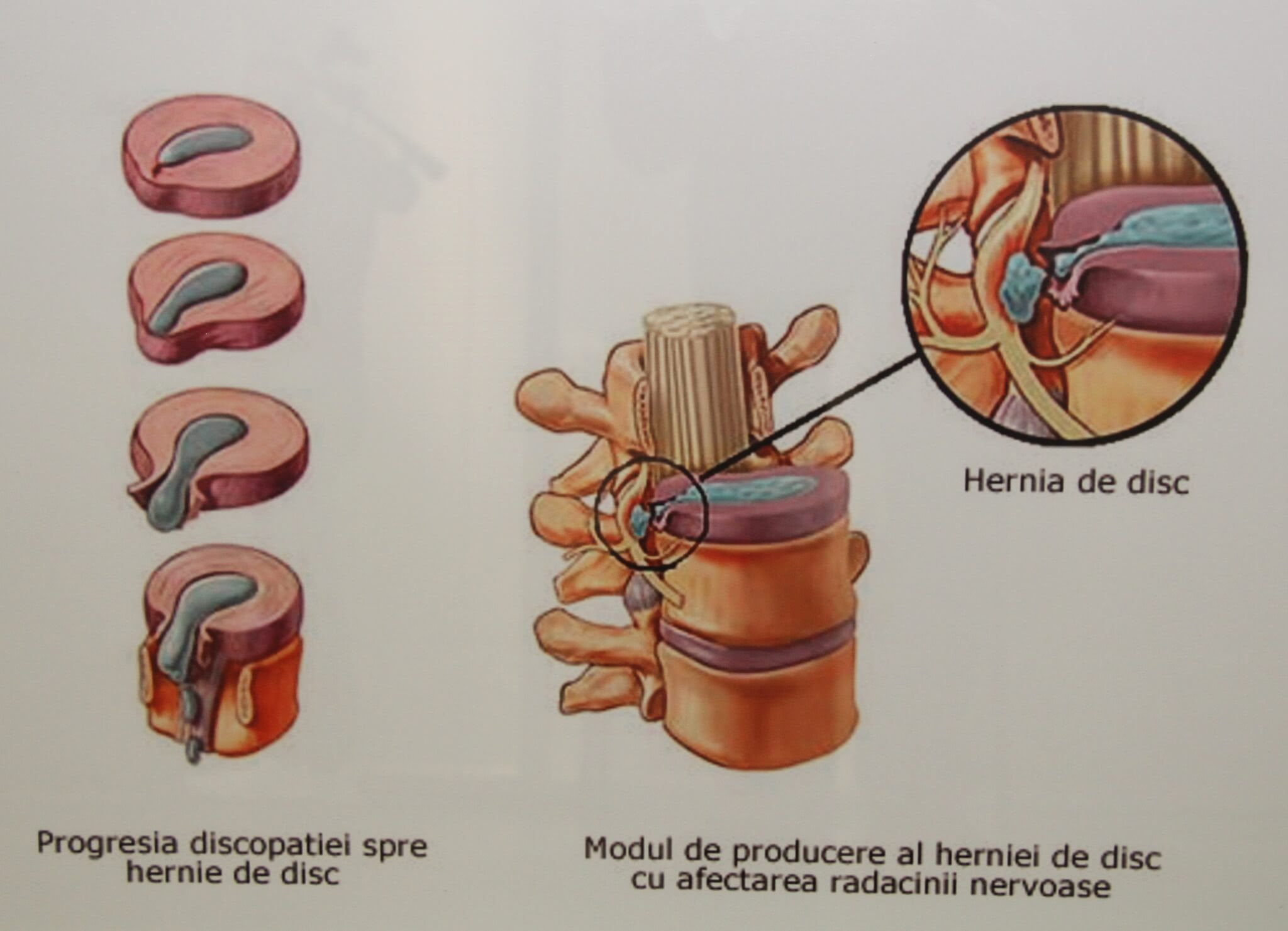 Hernia De Disc Cauze Simptome Tratament Nechirurgical