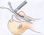Notfallintubation