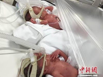 "Fantastic Four"; Woman Shocks Doctors After Giving Birth To Identical Quadruplets. Photos