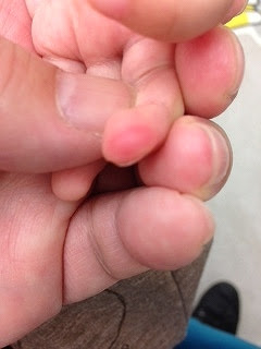 中心が白く色がぬけている湿疹 野田市 小児科 千葉県 こどもの花粉症 こどもの漢方 喘息 アトピー性皮膚炎 アレルギー 結節性痒疹 たんぽぽこどもクリニック