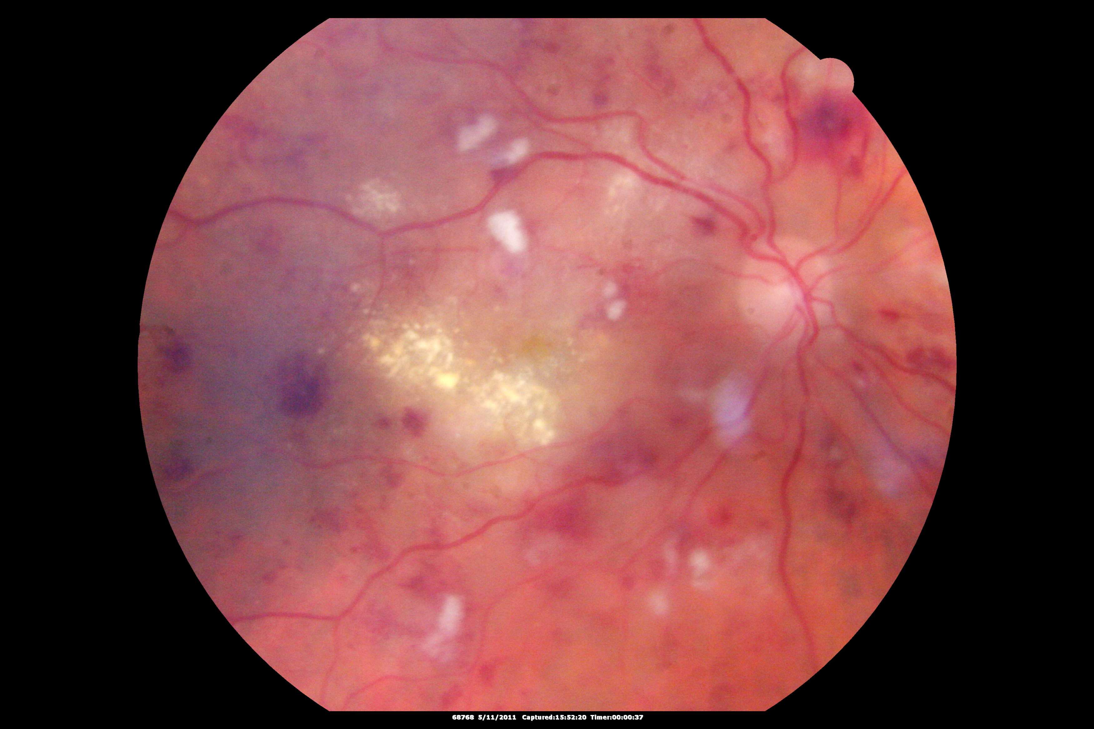 What Causes Dizziness? Nausea, Vertigo, Headache, During