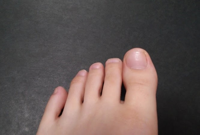 足爪が割れた時の処置はどうする 足の専門家が教える適切な対処法
