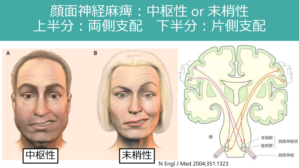 顔面単独の運動障害へのapproach 医学事始 いがくことはじめ