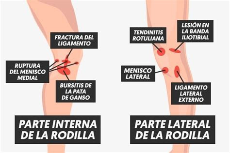 Es una gruesa y resistente aponeurosis que cubre toda la planta del pie, . Â¿CÃ³mo quitar el dolor de rodilla rÃ¡pido?