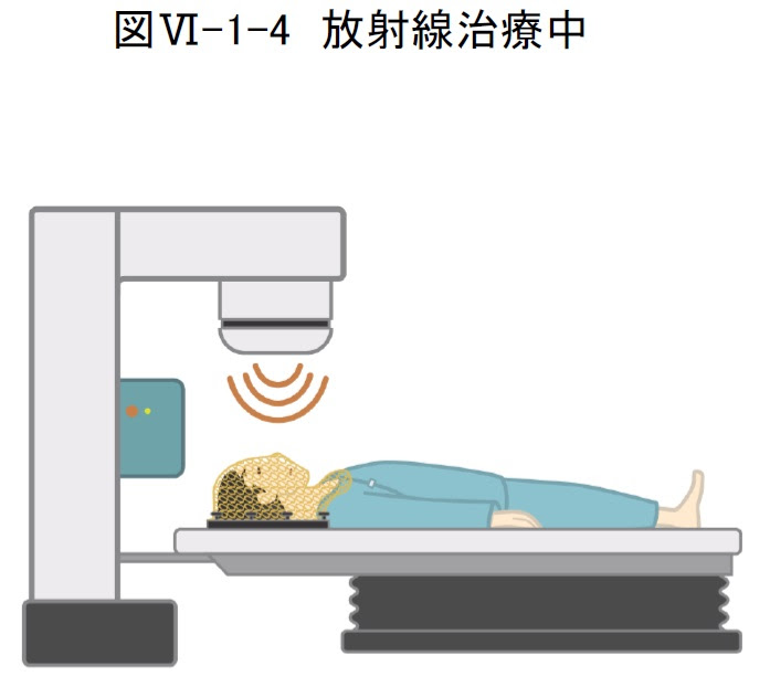 放射線治療 日本頭頸部癌学会 頭頸部がん情報