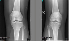 knee1