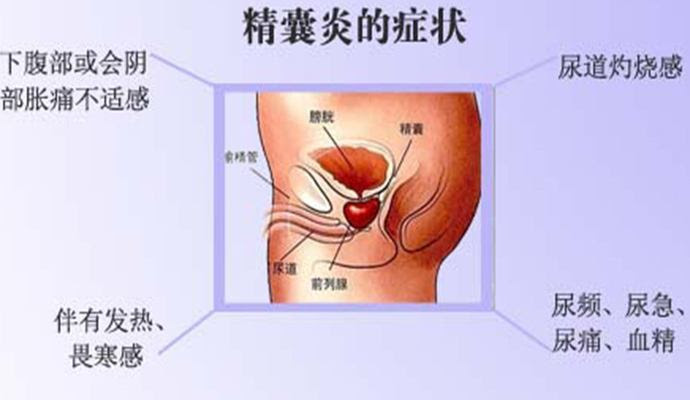 得了 血精 别紧张 在家先给自己做个初步诊断