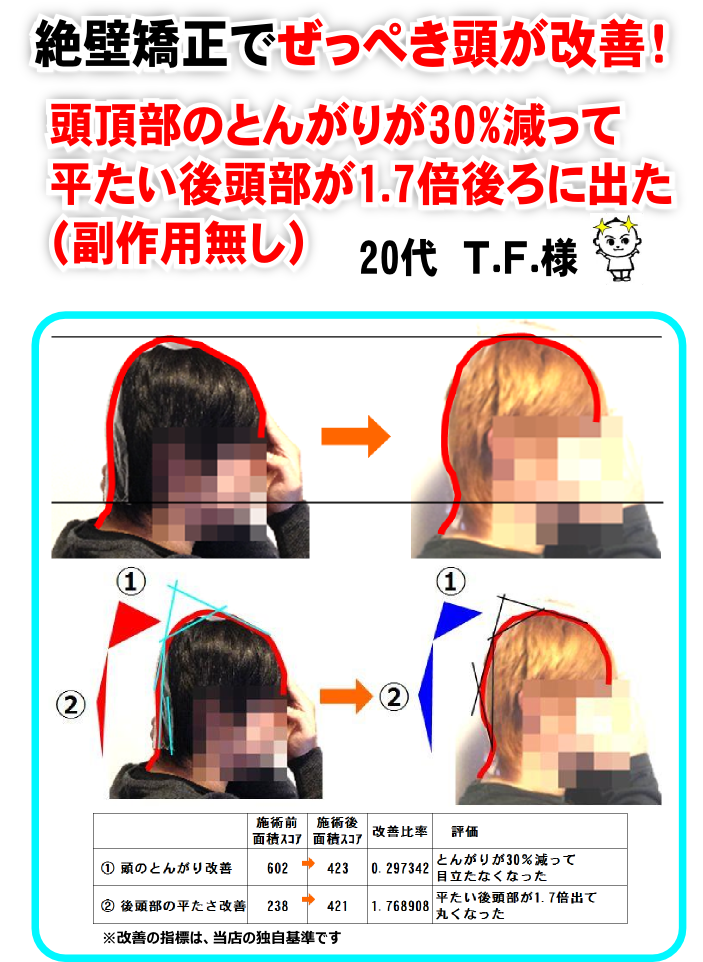 ぜっぺき頭が嫌でなおしたい方 髪型 ヘアアレンジが気になる方 ぜっぺき頭の矯正 オーストラリア州立大学カイロプラクティック医学の学位保持者がぜっぺき頭 を集中施術