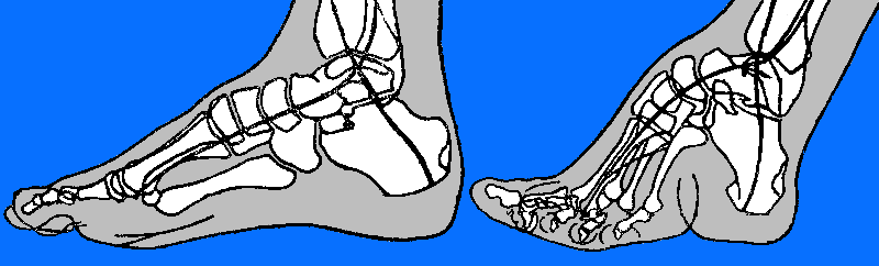 cross section of healthy foot and bound foot