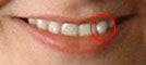 Marked tooth